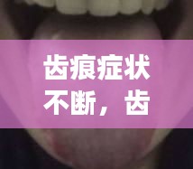 齿痕症状不断，齿痕严重吗 