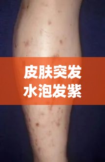 皮肤突发水泡发紫，皮肤紫色水泡 